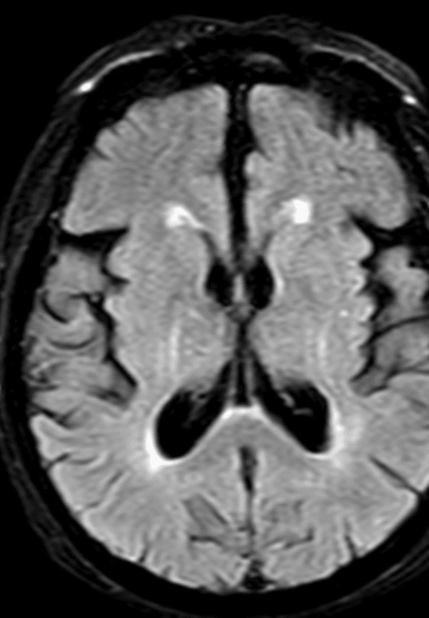Resonancia magnética cerebral en plano axial