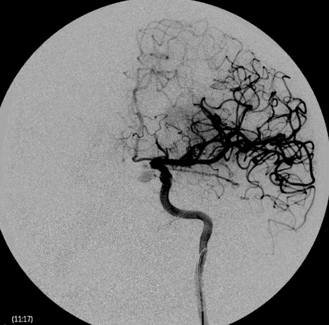 Imagen de angiografía cerebral