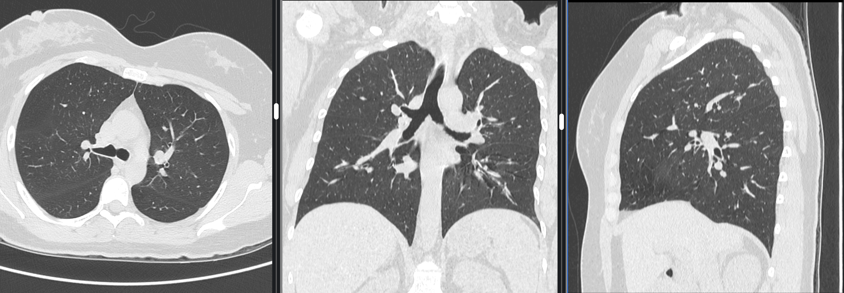 Tomografía computarizada de tórax en planos axial, coronal y sagital