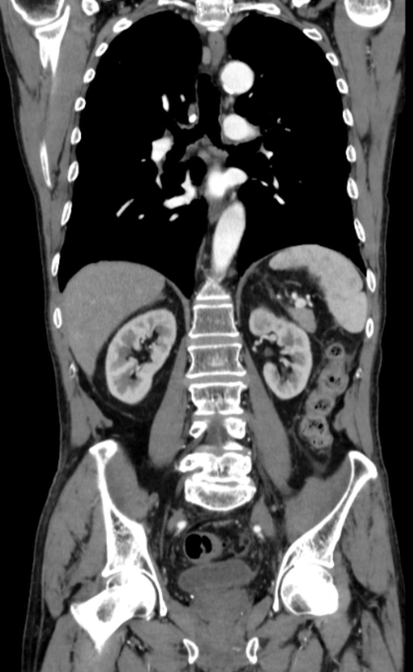 Imagen de tomografía computarizada de tórax y abdomen